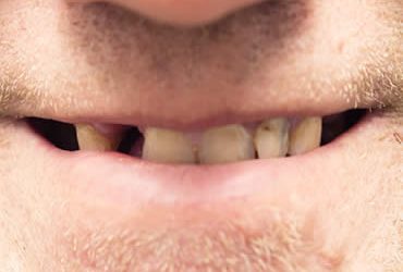 Ageless Smiles: A Comprehensive Guide to Oral Health Concerns for Middle-Aged Folks