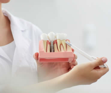 Are Dental Implants Safe?